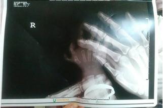 孩子出现多指畸形，该怎么办？