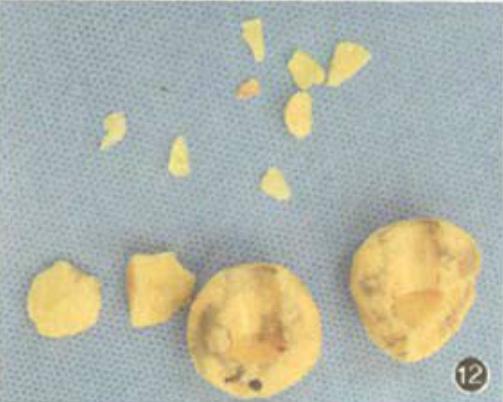 髋关节置换手术中内植物材料该如何选择？骨科医生告诉你