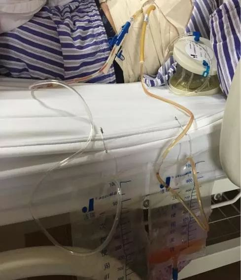 脑出血患者进入icu,全身插满管子,这算过度医疗吗?