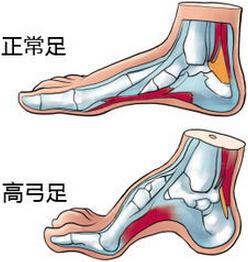 什么是高弓足  高弓足该怎么治疗