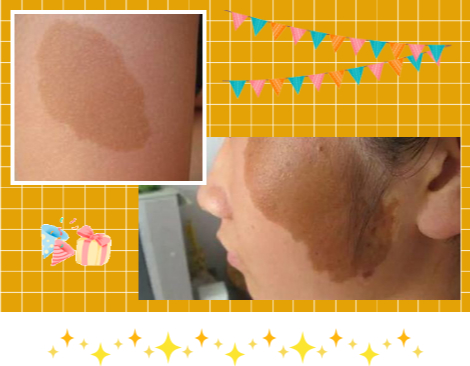 这些因素容易引起褐色胎记的复发因素