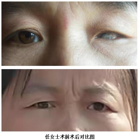 女子失明40载导致眼球萎缩义眼台植入术后重获自信