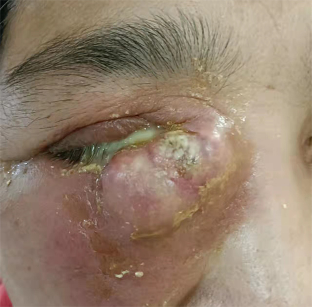 经过初步检查,王阿姨确诊为急性泪囊炎,通常由于慢性泪囊炎没有得到