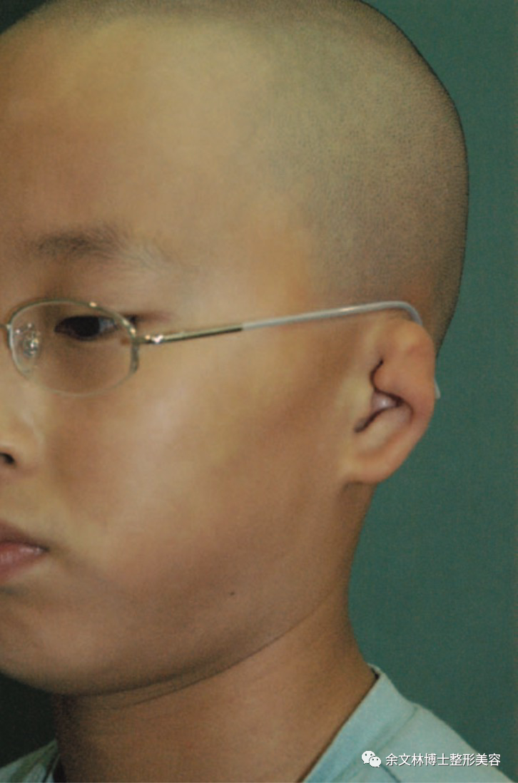 杯状耳的手术治疗