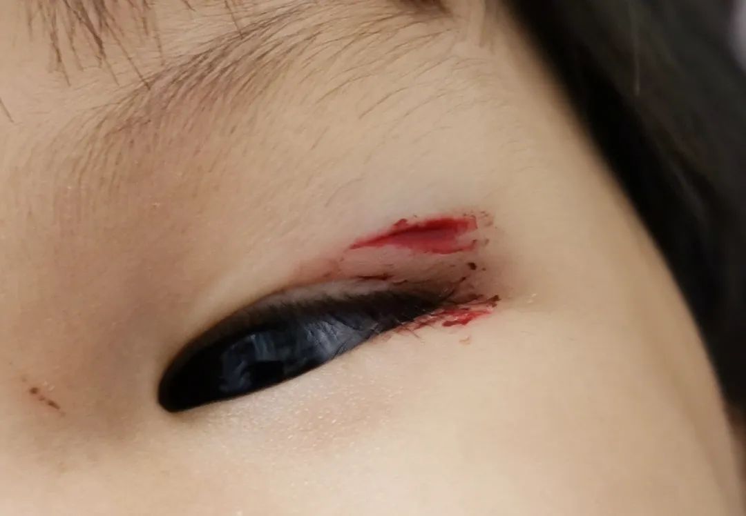 孩子被玩具划伤眼皮出血了(眼睑裂伤)!家长当即做了这个决定