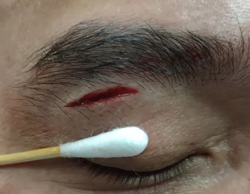 孩子被玩具划伤眼皮出血了(眼睑裂伤)!