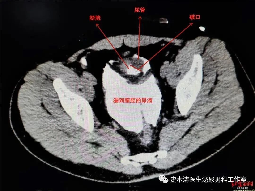 膀胱ct解剖图片