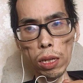 34岁博主得肠癌一年后变“老人”，出现这5种情况要小心→