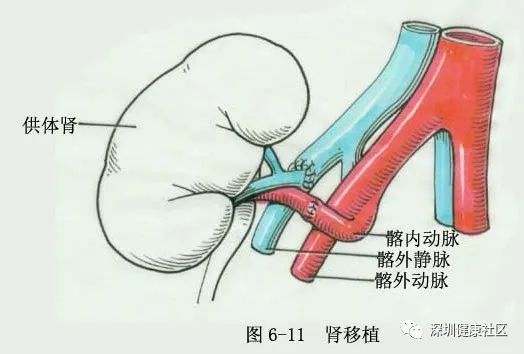 肾积水插管手术图解图片