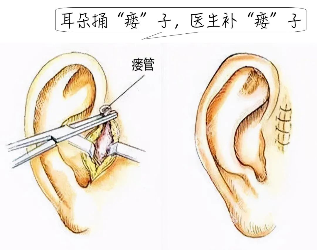 医生拿起一次性剃刀三两下把我耳鬓的头发剃了