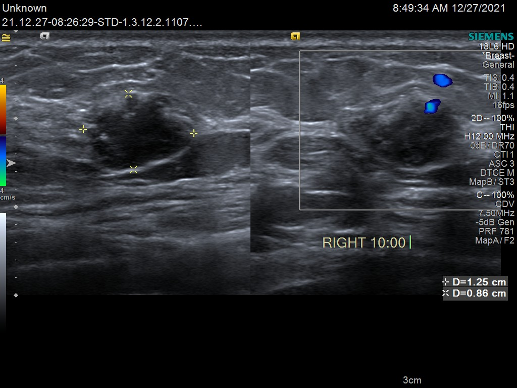 乳腺癌早期彩超图片图片