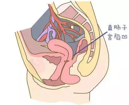 盆腔积液可以同房吗图片