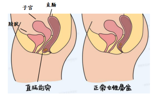 直肠前突即直肠前壁突出,是直肠阴道隔薄弱直肠前壁突入阴道内的一种