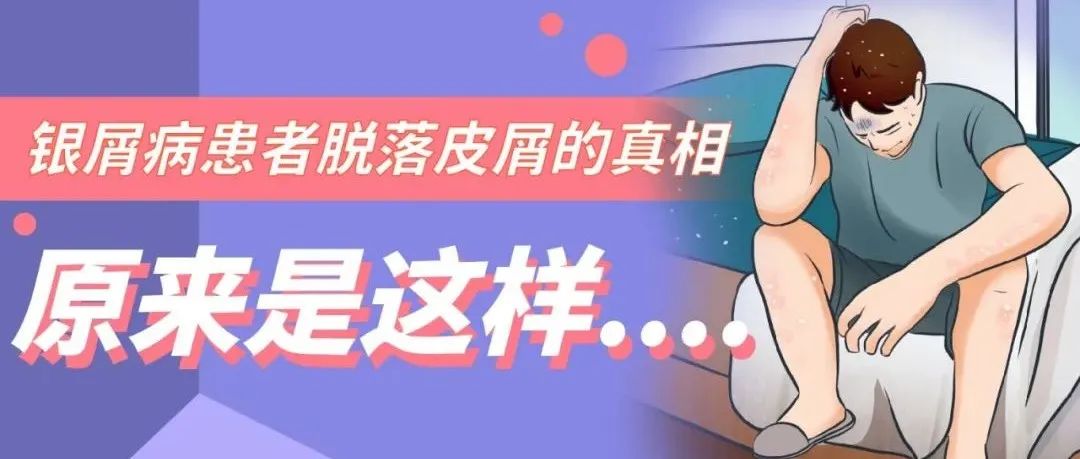 银屑病患者脱落皮屑的真相，原来是这样…
