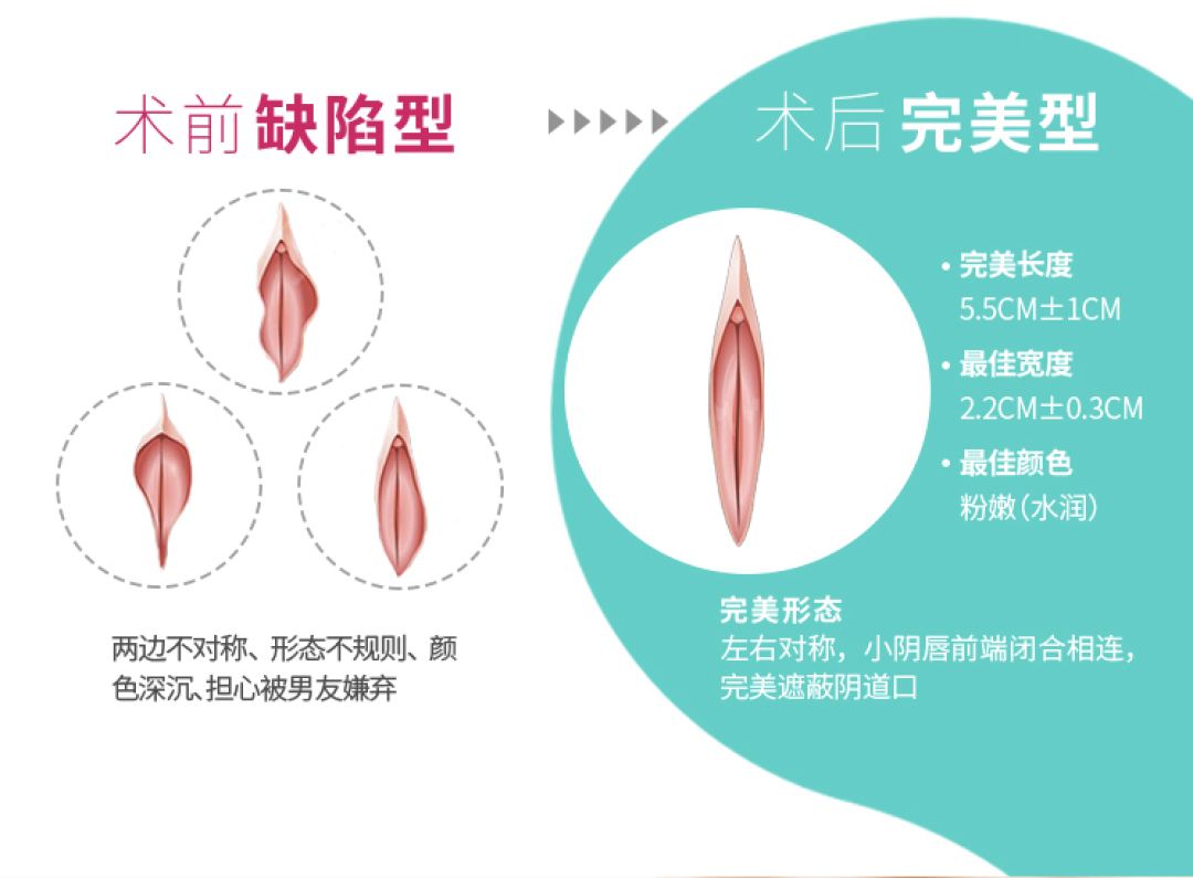小阴唇 科普文章