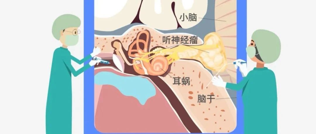 长期耳鸣、听力下降、眩晕，小心听神经瘤！