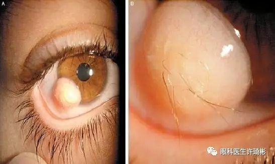 戈尔登哈尔综合征(Goldenhar Syndrome)