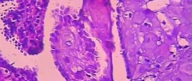 罕见的内分泌肿瘤——甲状旁腺癌，只占全身患肿瘤概率的0.5%
