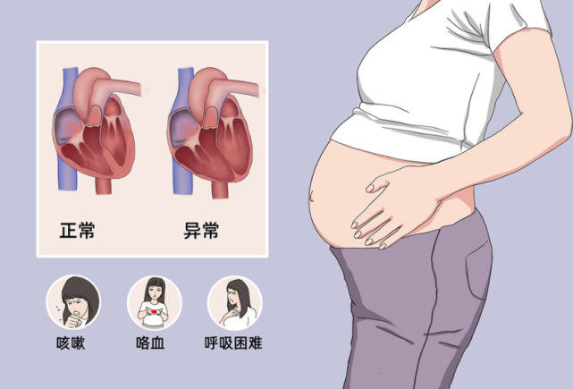 怀孕后出现呼吸困难是什么原因？小心围产期心肌病！