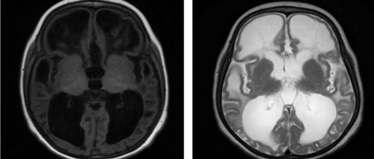 脑白质病变之伴皮质下囊肿的巨脑性脑白质病