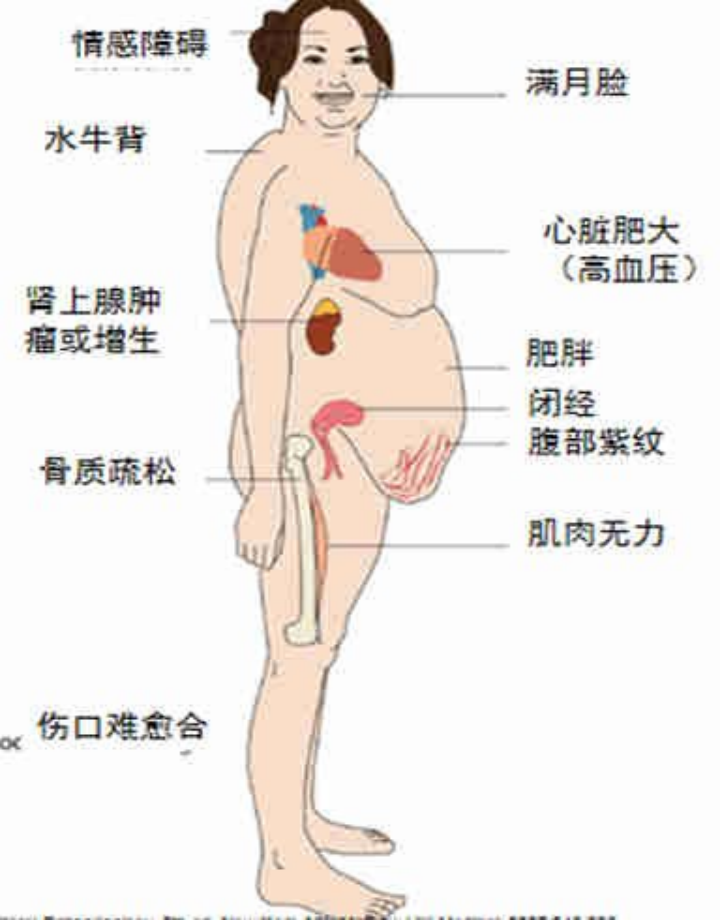 水牛背向心性肥胖图片图片