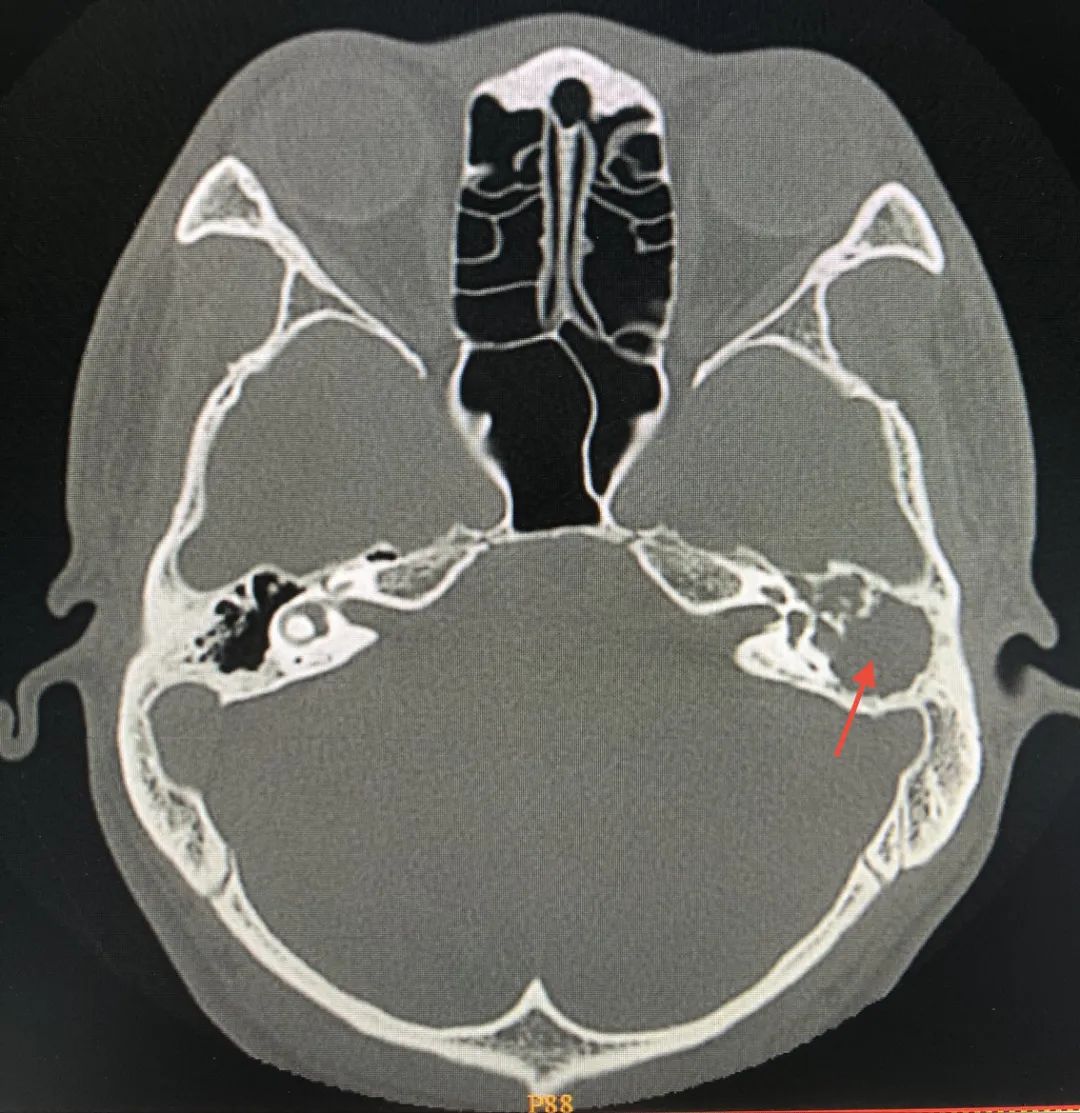 中耳胆脂瘤CT图片