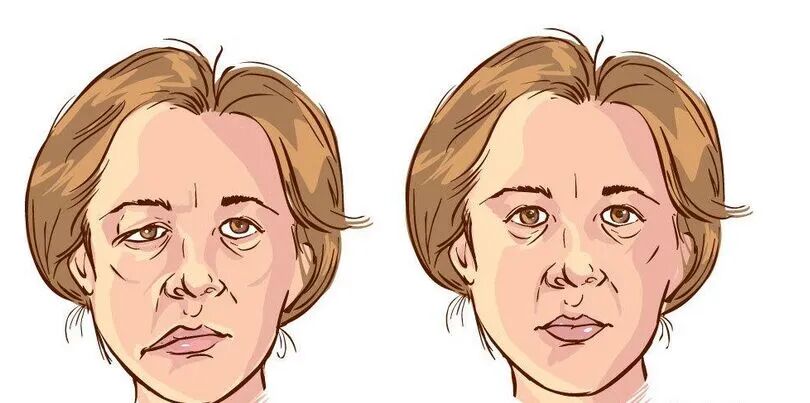 面瘫图片_面瘫症状表现图片大全_有来医生